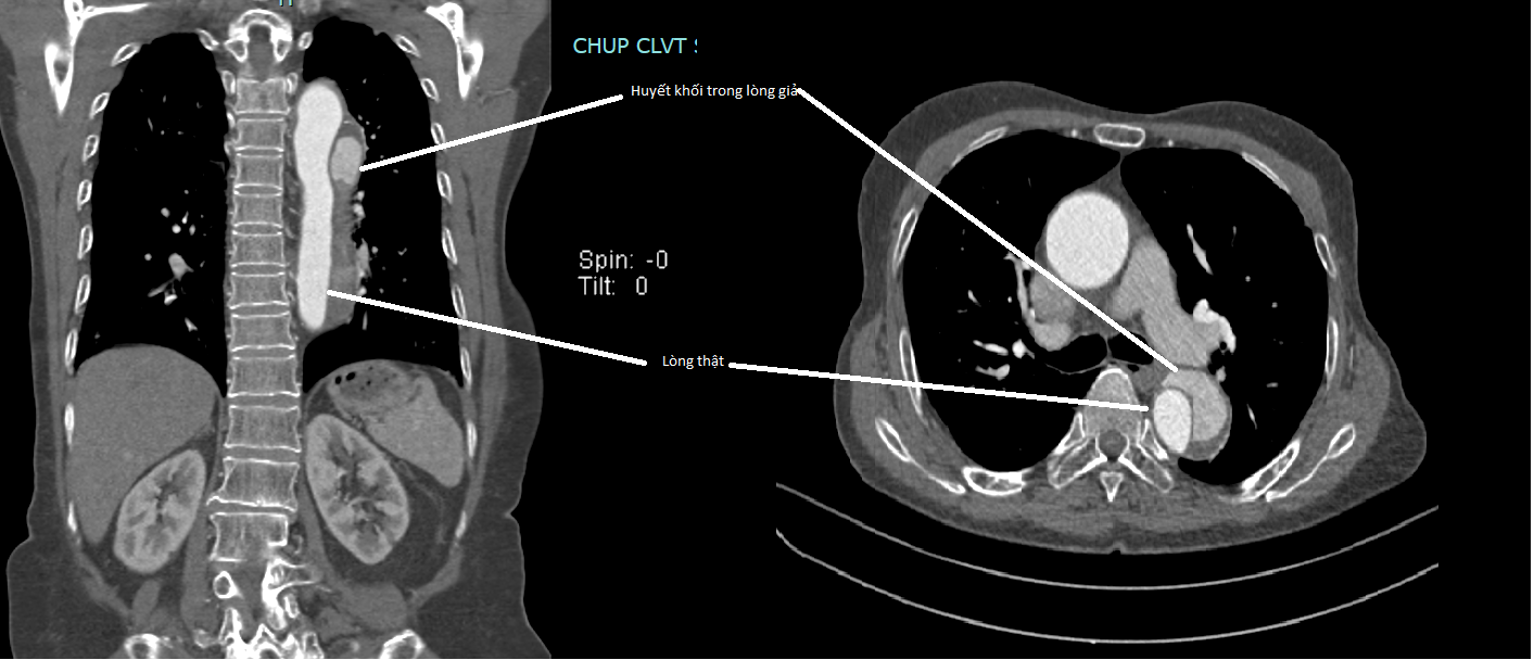 Hình ảnh chụp CLVT động mạch chủ ngực của bệnh nhân