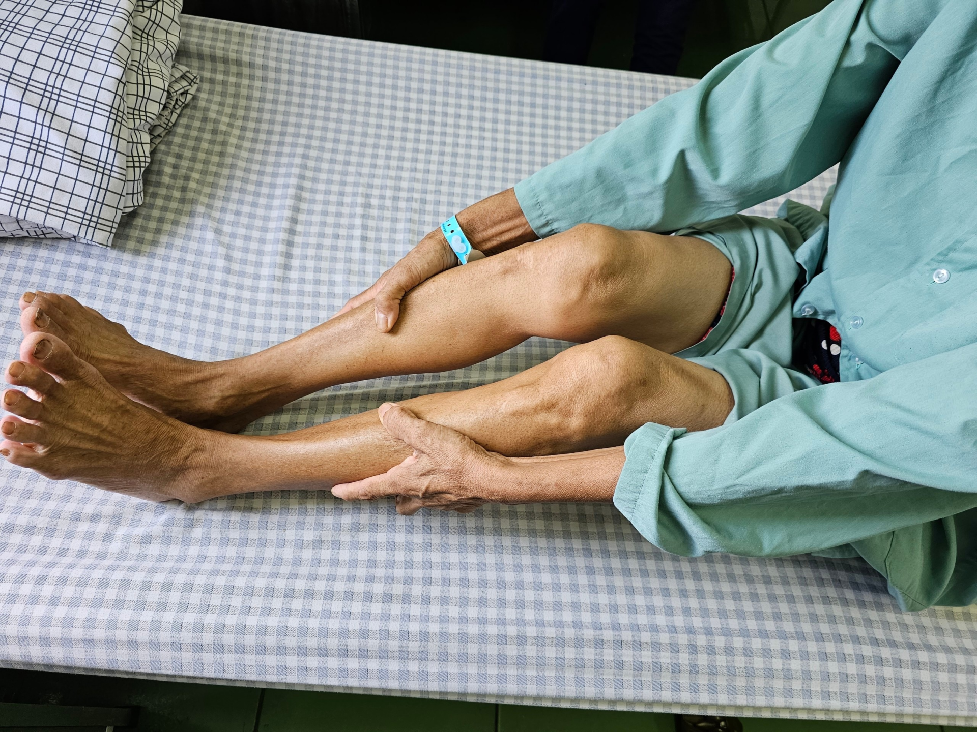 Người bệnh loãng xương bị đau dọc xương cẳng chân