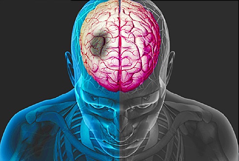 Hình ảnh tắc động mạch não giữa do rung nhĩ
