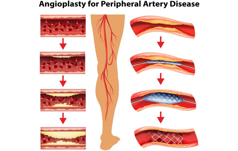 Hình ảnh tắc động mạch chi dưới (bên trái) và can thiệp nội mạch động mạch chi dưới (bên phải)