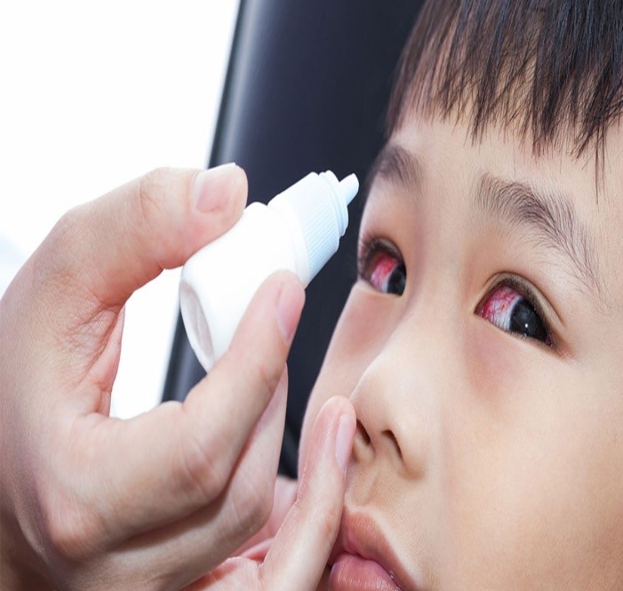 Thận trọng sử dụng thuốc trong dịch đau mắt đỏ