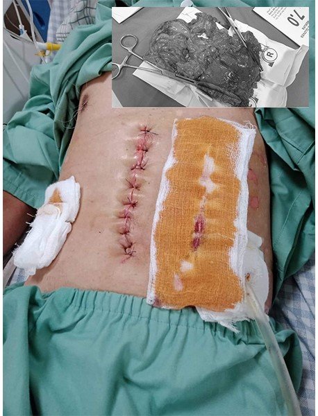 Hình ảnh của người bệnh sau khi mới cắt bỏ ¾ dạ dày