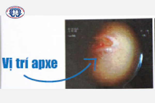 Hình ảnh ổ apxe cạnh hậu môn trong nội soi