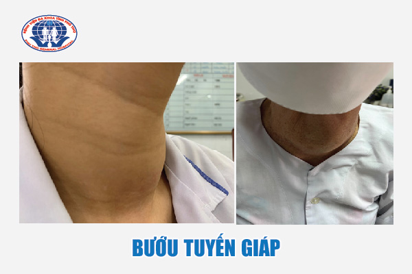 Hình ảnh người bệnh bị bướu nhân tuyến giáp tại khoa Nội tiết – Đái tháo đường, Bệnh viện đa khoa tỉnh Phú Thọ