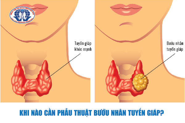 Khi nào cần phẫu thuật bướu nhân tuyến giáp?