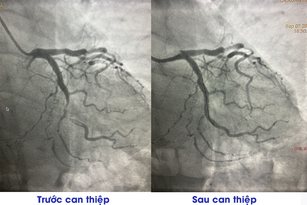 Hình ảnh chụp động mạch vành của người bệnh nhồi máu cơ tim trước và sau can thiệp