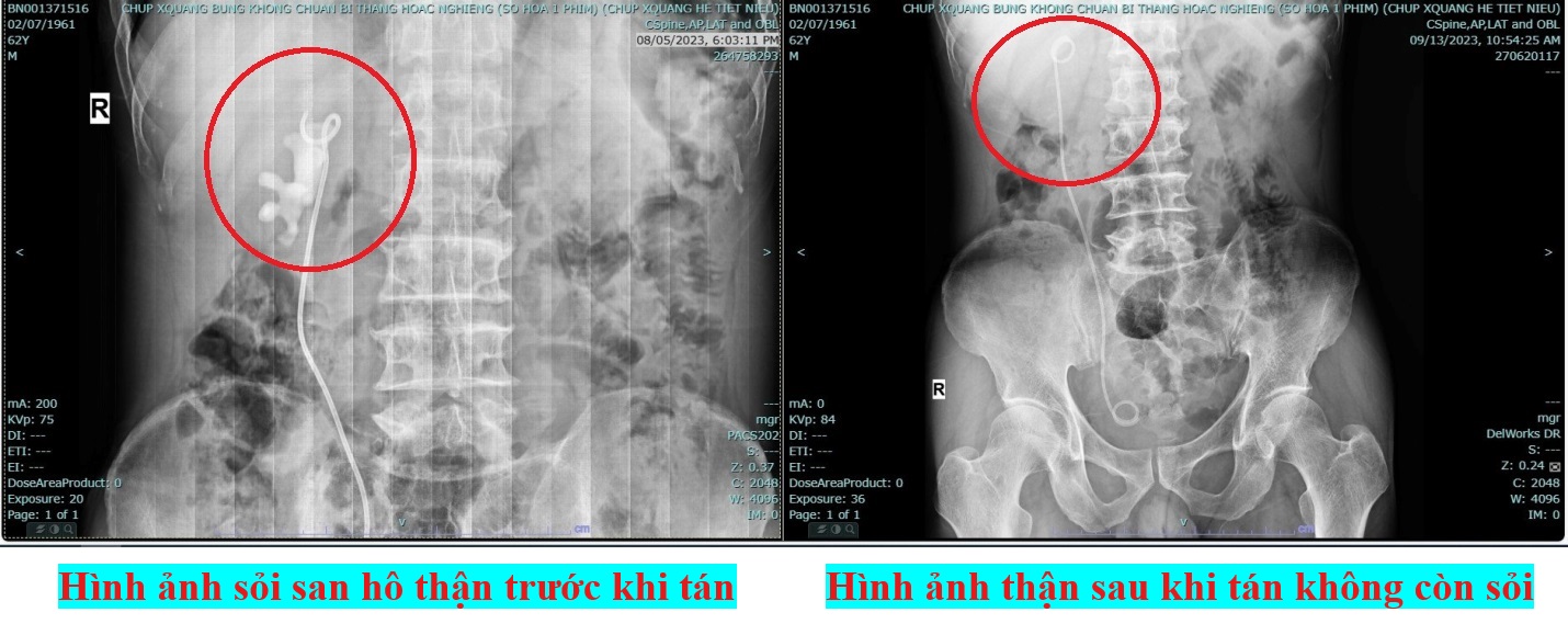 Hình 2; Hình ảnh trước và sau khi người bệnh thực hiện kĩ thuật tán sỏi nội soi ống mềm