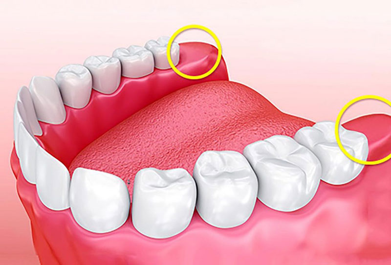 Răng khôn là răng mọc cuối cùng của hàm răng