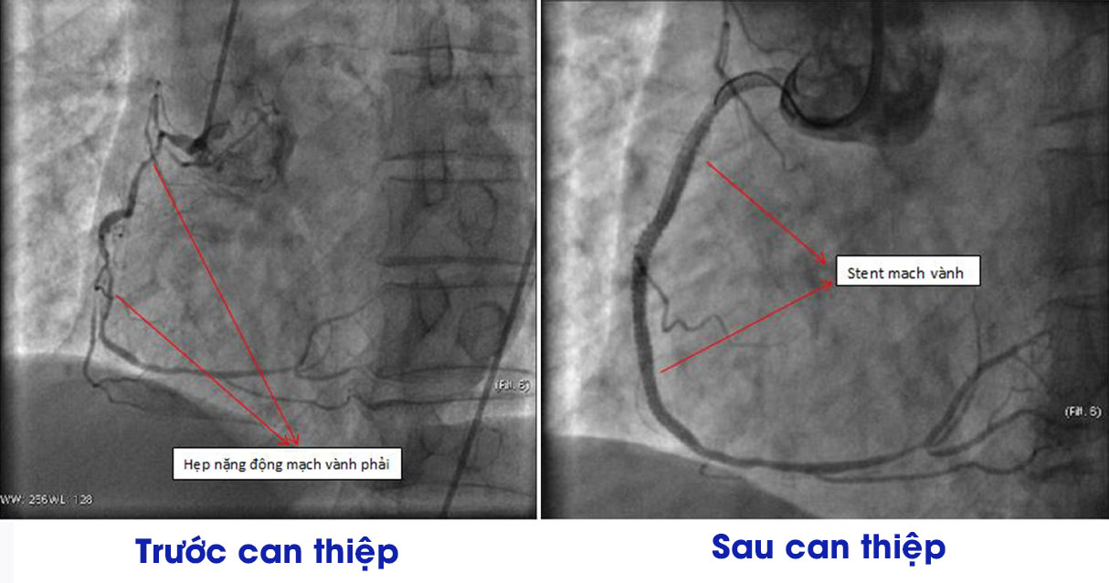 Hình ảnh chụp động mạch vành trước và sau can thiệp