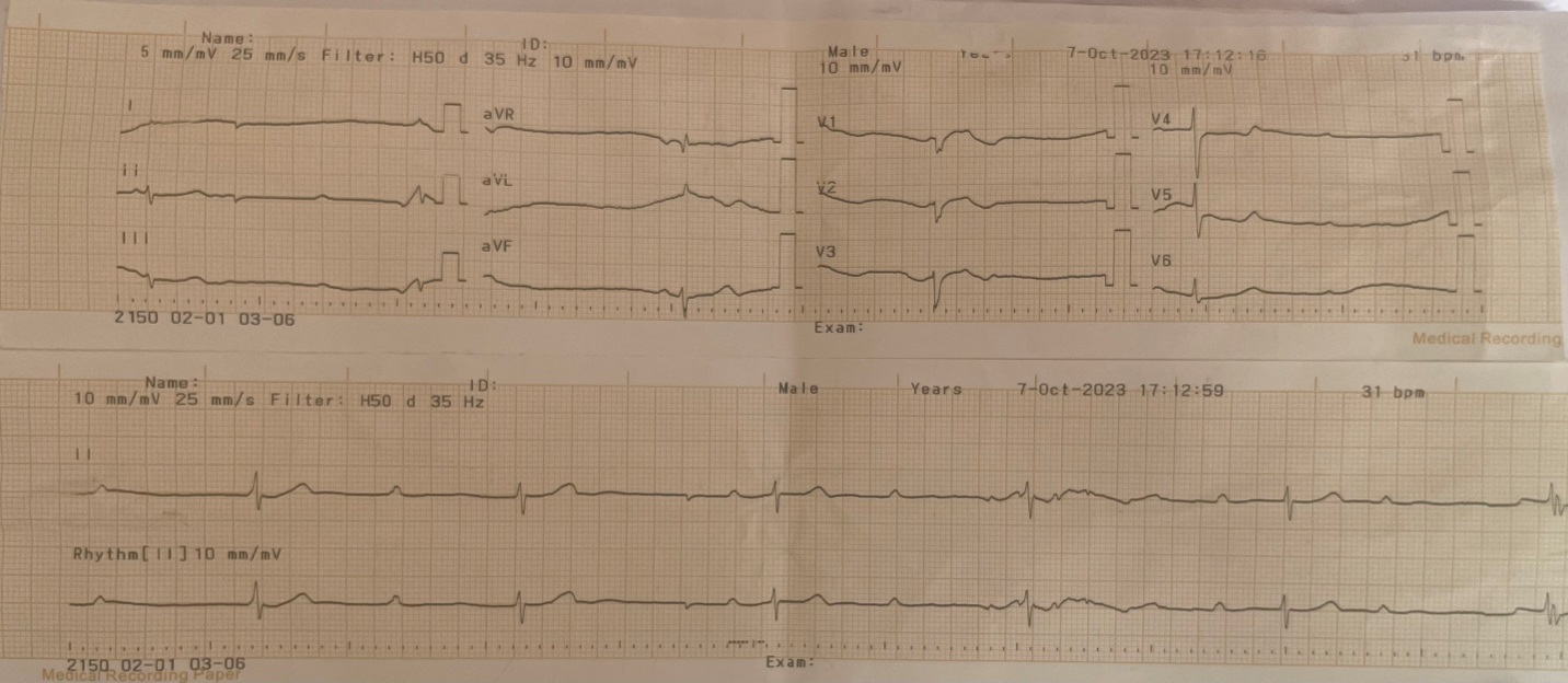 Hình ảnh điện tim của người bệnh khi nhập viện (Block nhĩ thất cấp 3 tần số rất chậm 31ck/phút)