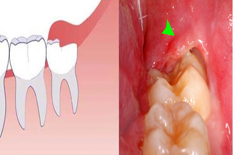 Răng khôn gần như không có tác dụng về mặt thẩm mỹ và chức năng nhai