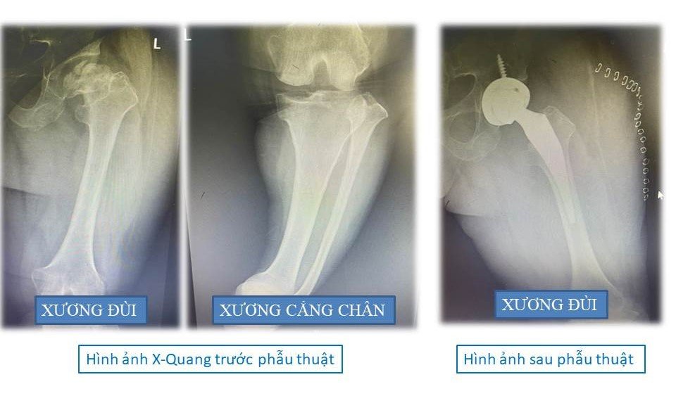 Hình ảnh chụp cận lâm sàng X-quang trước và sau trước phẫu thuật của người bệnh P.T.C