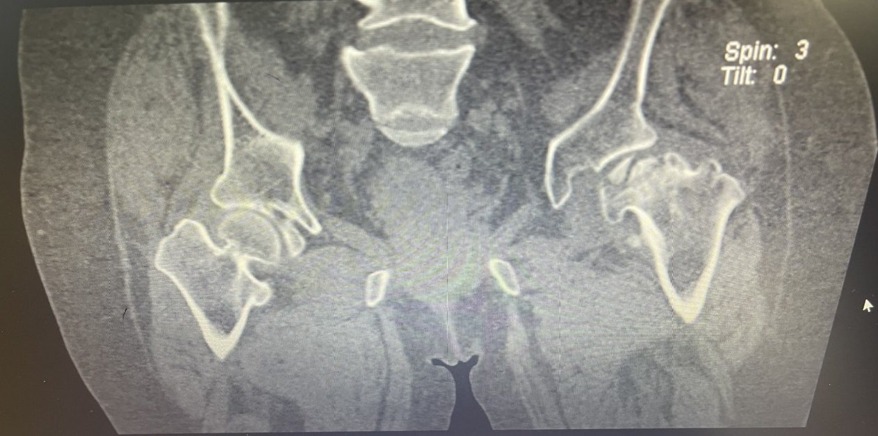 Hình ảnh chụp CT trước phẫu thuật của người bệnh P.T.C
