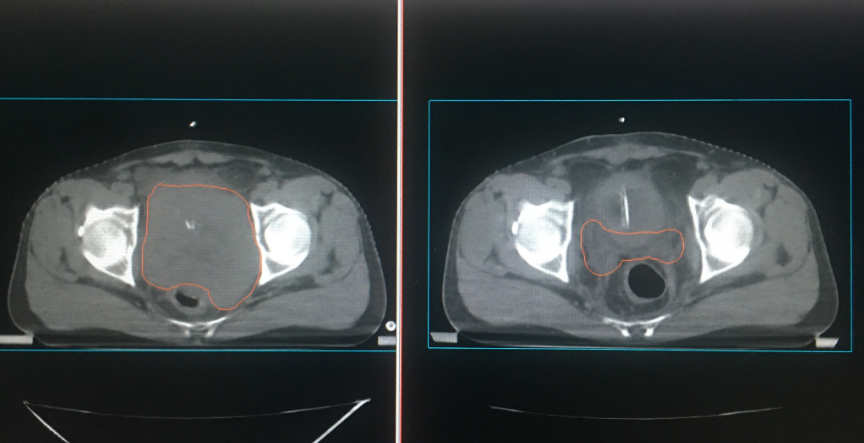 Hình ảnh khối u trước và sau khi điều trị cho người bệnh