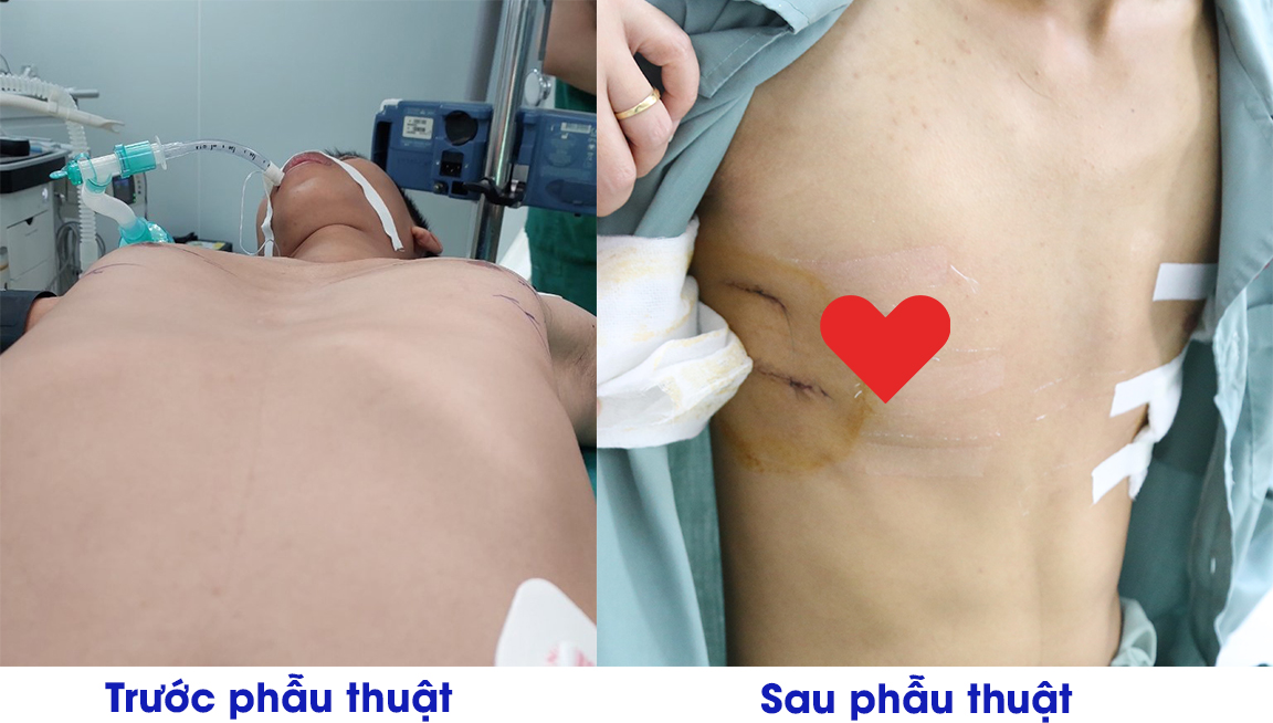 Hình ảnh ngực của người bệnh trước và sau phẫu thuật