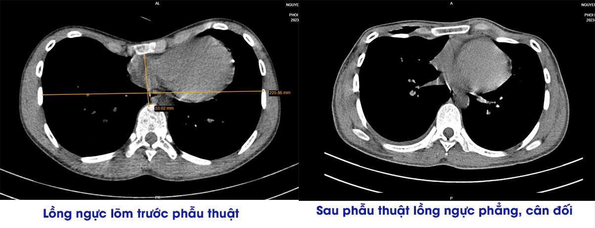 Hình ảnh phim chụp của người bệnh lõm ngực trước và sau phẫu thuật