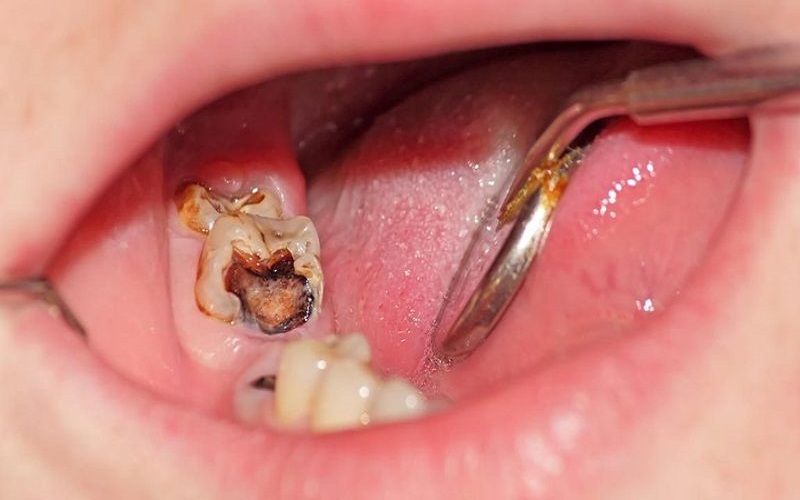 Có nhiều phương pháp điều trị sâu răng hiệu quả tùy thuộc vào mức độ bị sâu của răng