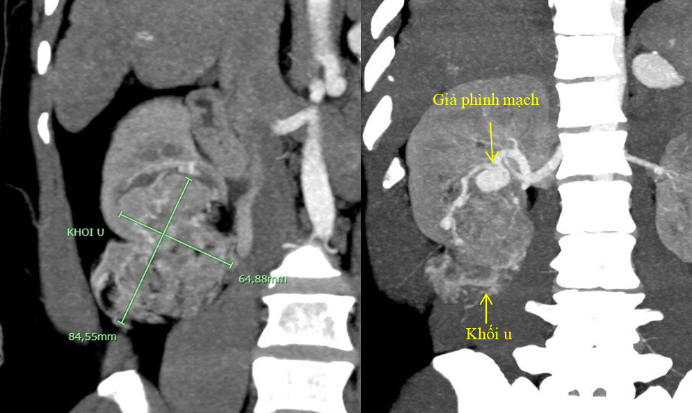 Hình ảnh khối u thận và giả phình nhánh động mạch thận nuôi u trên phim chụp cắt lớp vi tính 128 dãy có sử dụng kỹ thuật tái tạo và dựng hình đa bình diện