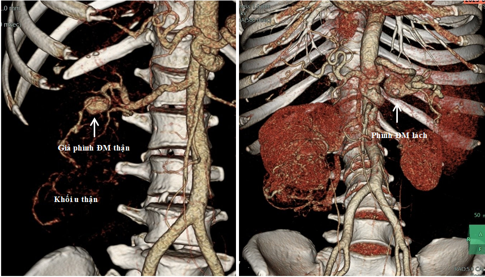 Hình ảnh khối u thận và giả phình nhánh động mạch thận nuôi u (phải) và hình phình động mạch lách (trái) trên phim chụp cắt lớp vi tính 128 dãy có sử dụng kỹ thuật dựng hình 3D mạch máu