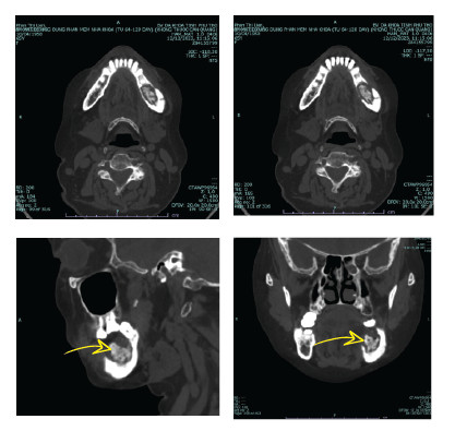 Hình ảnh chụp cắt lớp vi tính vùng hàm mặt của người bệnh trước khi được điều trị tại Bệnh viện đa khoa tỉnh Phú Thọ