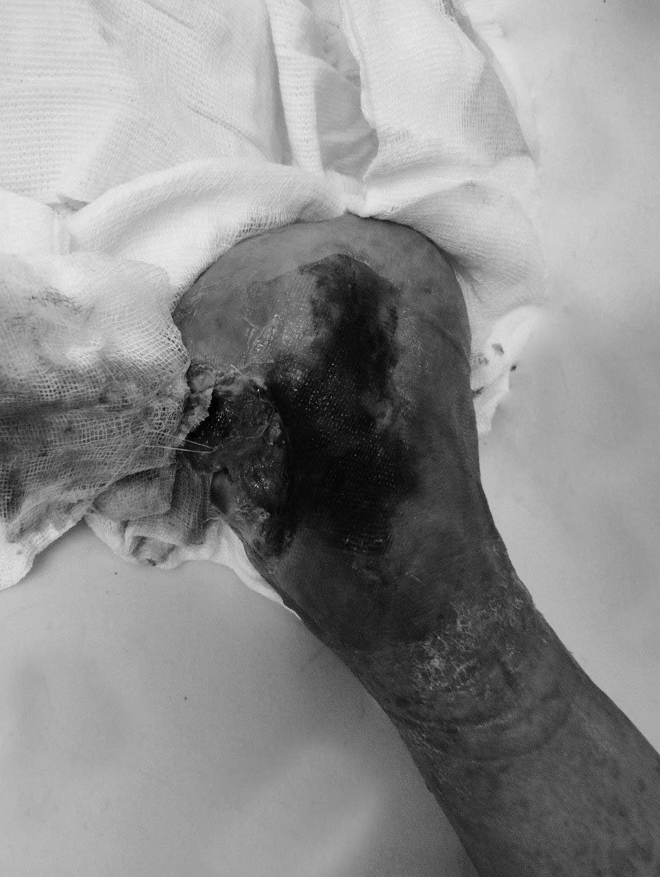 Hình ảnh chân người bệnh khi đến bệnh viện mỏm cụt chân trái vẫn tiếp tục hoại tử