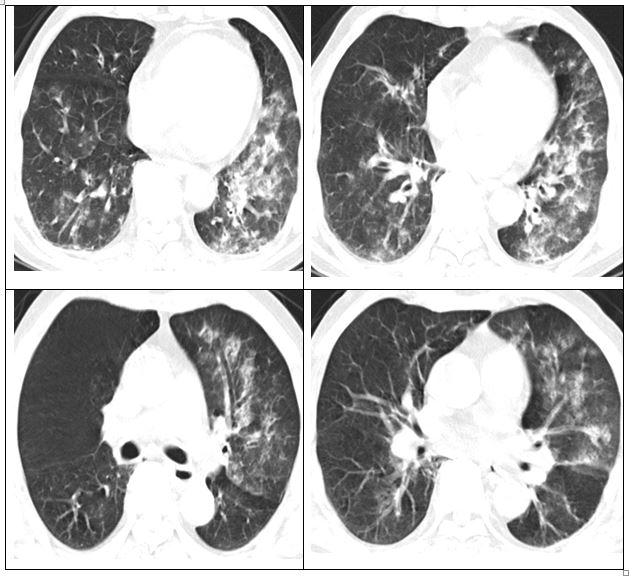Hình ảnh phổi của người bệnh bị viêm lan tỏa và đông đặc