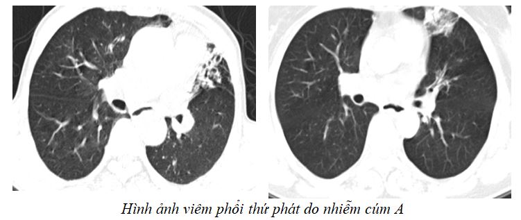 Hình ảnh viêm phổi thứ phát do nhiễm cúm A