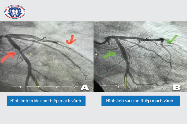Hình ảnh trước và sau can thiệp mạch vành của người bệnh đã được tái thông