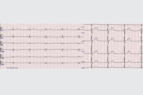 Hình ảnh điện tâm đồ của người bệnh bị đái tháo đường biến chứng tim mạch khi nhập viện