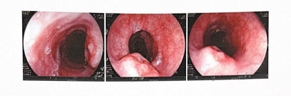 Hình ảnh hạ họng – thực quản của người bệnh  trước khi được điều trị