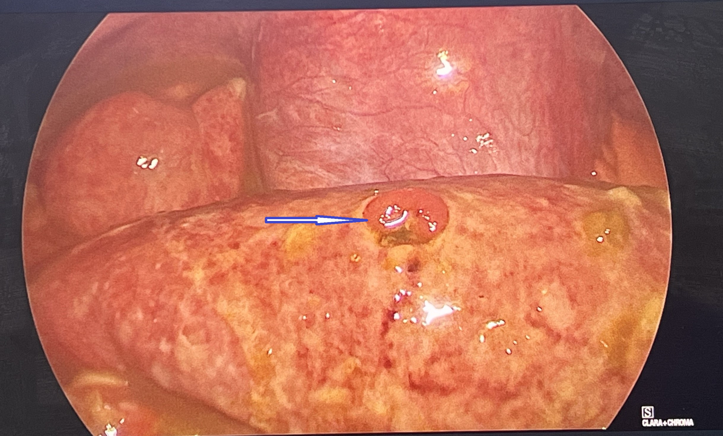 Hình ảnh nội soi trước phẫu thuật: ruột non vỡ
