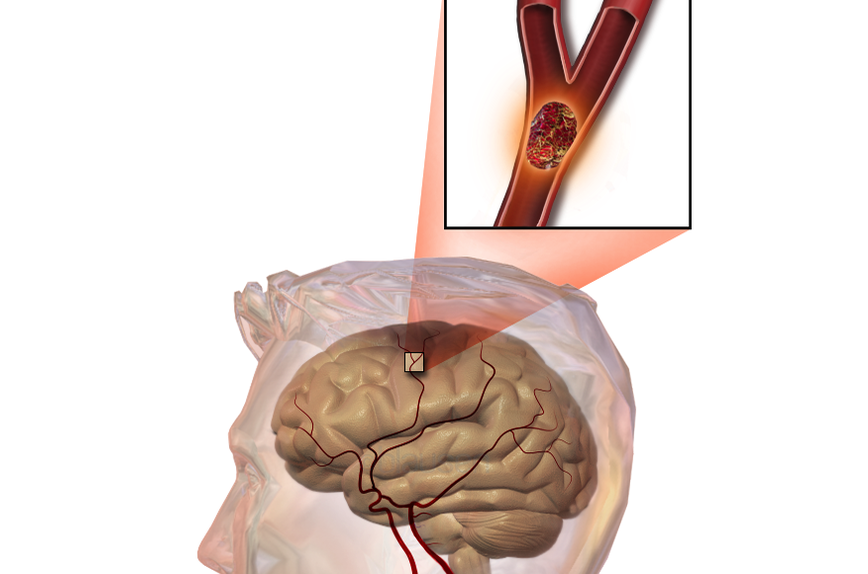 Hình ảnh minh họa: Huyết khối (cục máu đông) trong mạch máu não