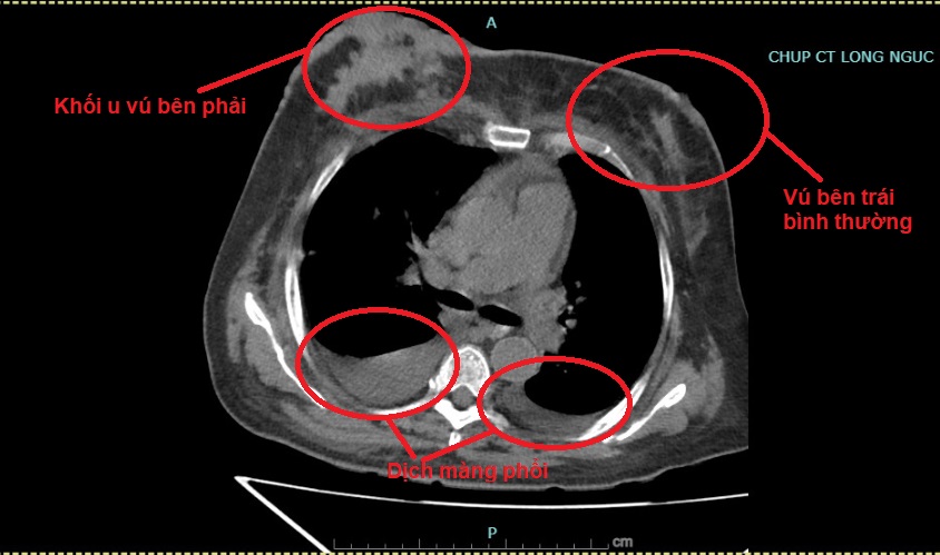 Hình ảnh người bệnh có khối u vú bên phải và dịch màng phổi khi nhập viện