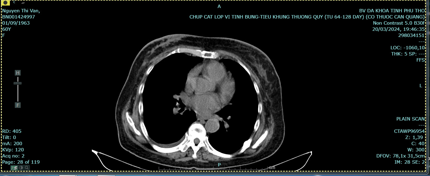 Hình ảnh khối u vú và dịch màng phổi gần như biến mất sau 2 liệu trình điều trị