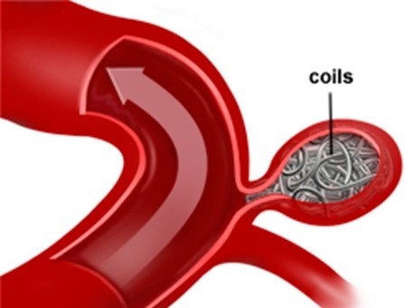 Hình ảnh minh họa kĩ thuật nút coils
