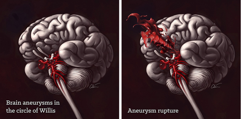 Hình ảnh phình động mạch não chưa vỡ (trái) và vỡ (phải) (nguồn: artibiotics.com)