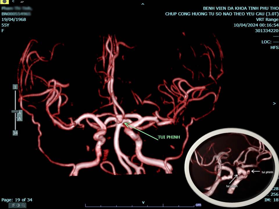 Hình ảnh túi phình mạch máu não từ máy chụp cộng hưởng từ 3.0 Tesla