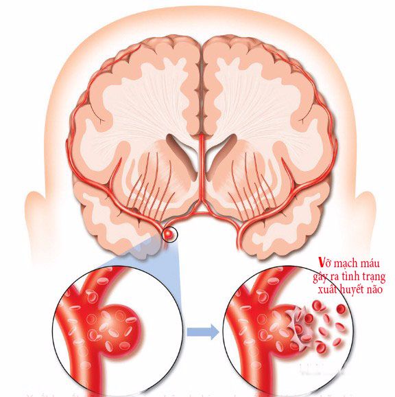 Hình ảnh minh họa vỡ túi phình mạch dẫn đến chảy máu não