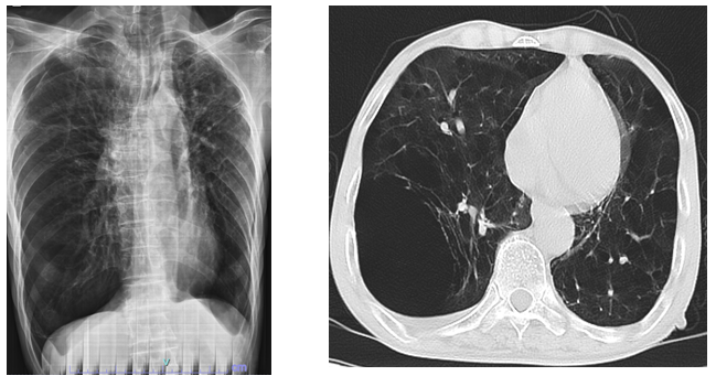 Hình ảnh tổn thương phổi ở người bệnh bệnh mắc COPD (kén khí, giãn phế nang)