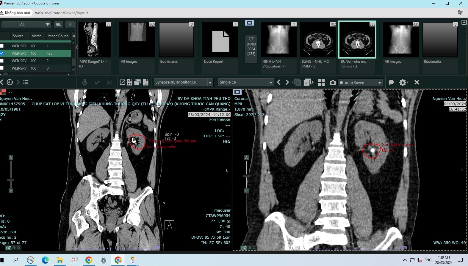 Kết quả chụp CT cho thấy người bệnh bị sỏi một viên ở đài thận kích thước 1cm.