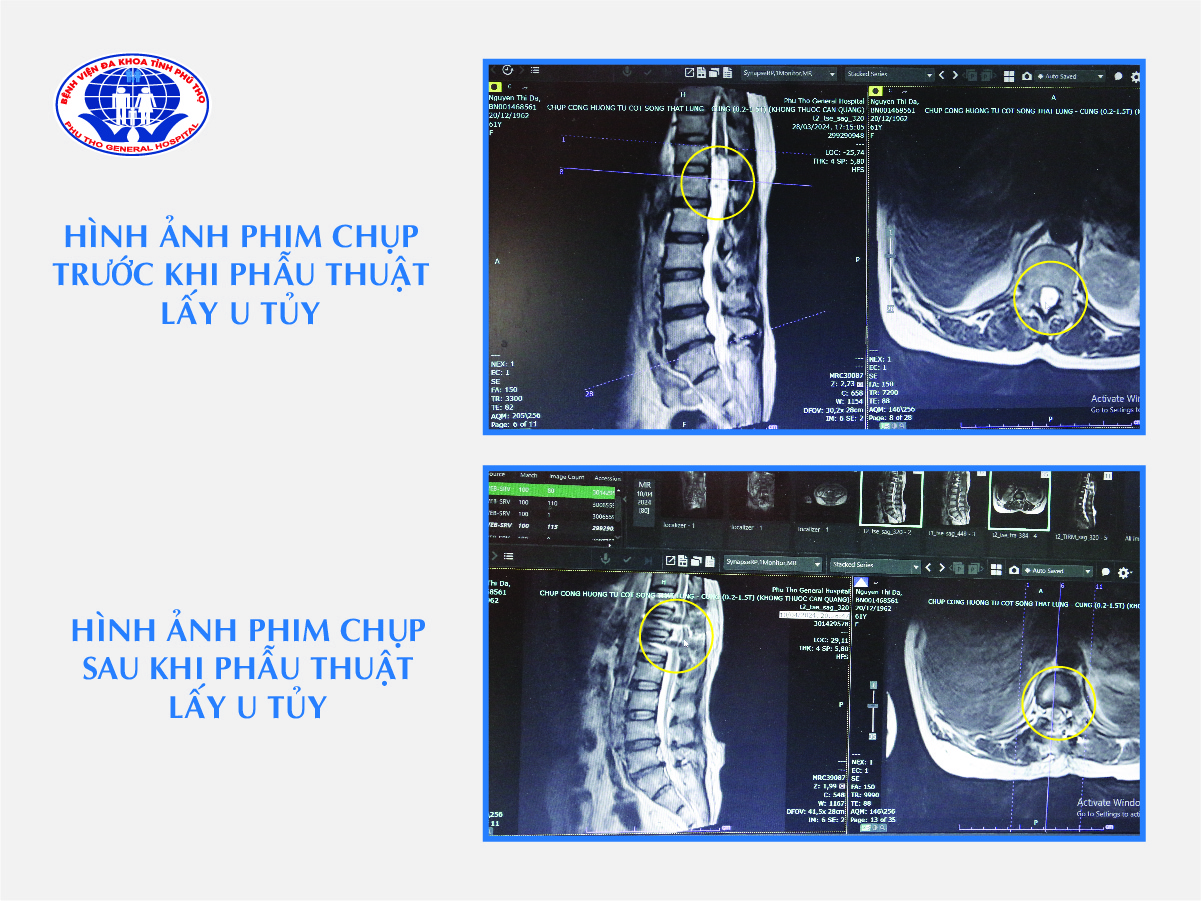 Hình ảnh phim chụp trước và sau khi phẫu thuật lấy u tủy