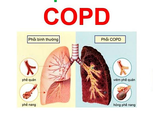 Ảnh minh họa: Phổi của người bình thường và người mắc bệnh phổi tắc nghẽn mạn tính COPD