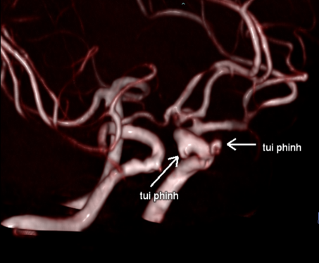 Hình ảnh túi phình động mạch ở người bệnh nam 62 tuổi được chụp cộng hưởng từ 3.0 Tesla tại BVĐK tỉnh Phú Thọ