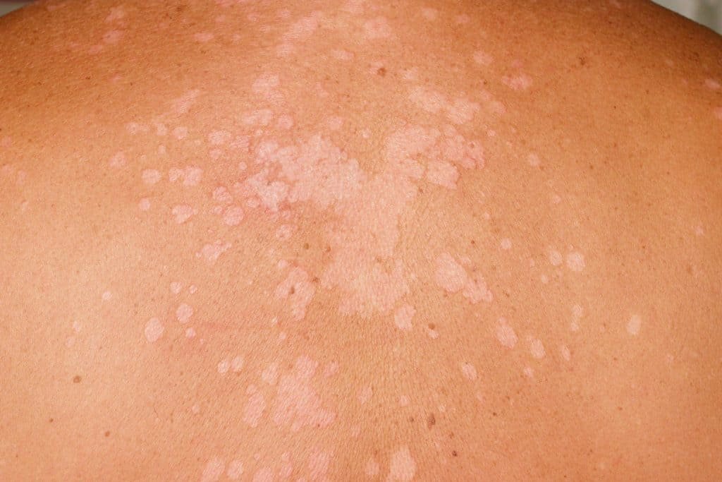 Nấm da thường xuất hiện dưới dạng phát ban có vảy, da đổi màu và thường gây ngứa