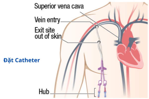 Minh họa phương pháp đặt catheter tạo đường hầm cuff