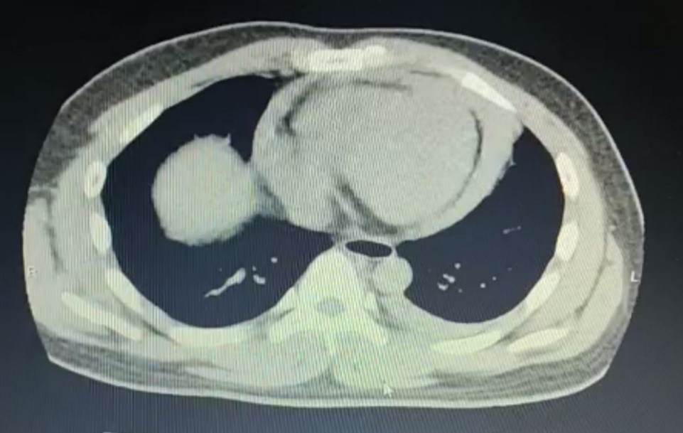 Hình ảnh tràn dịch màng tim gây ép tim trên phim chụp tại Trung tâm Y tế huyện Cẩm khê
