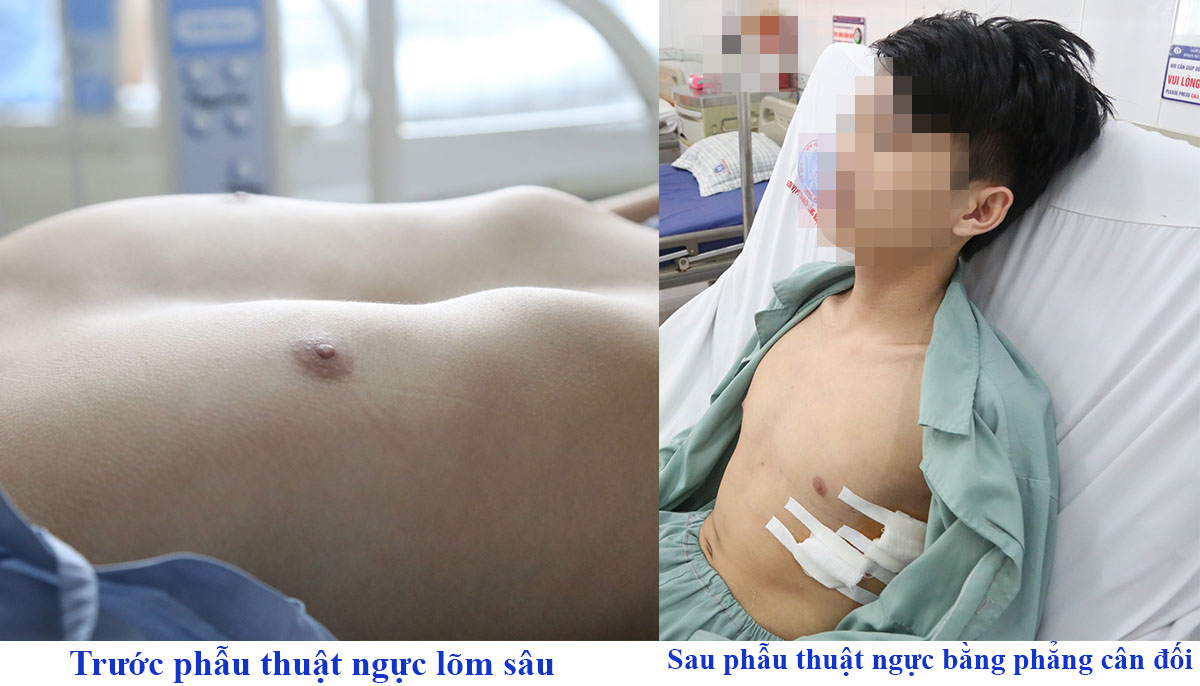 Hình ảnh lõm ngực của người bệnh trước và sau phẫu thuật