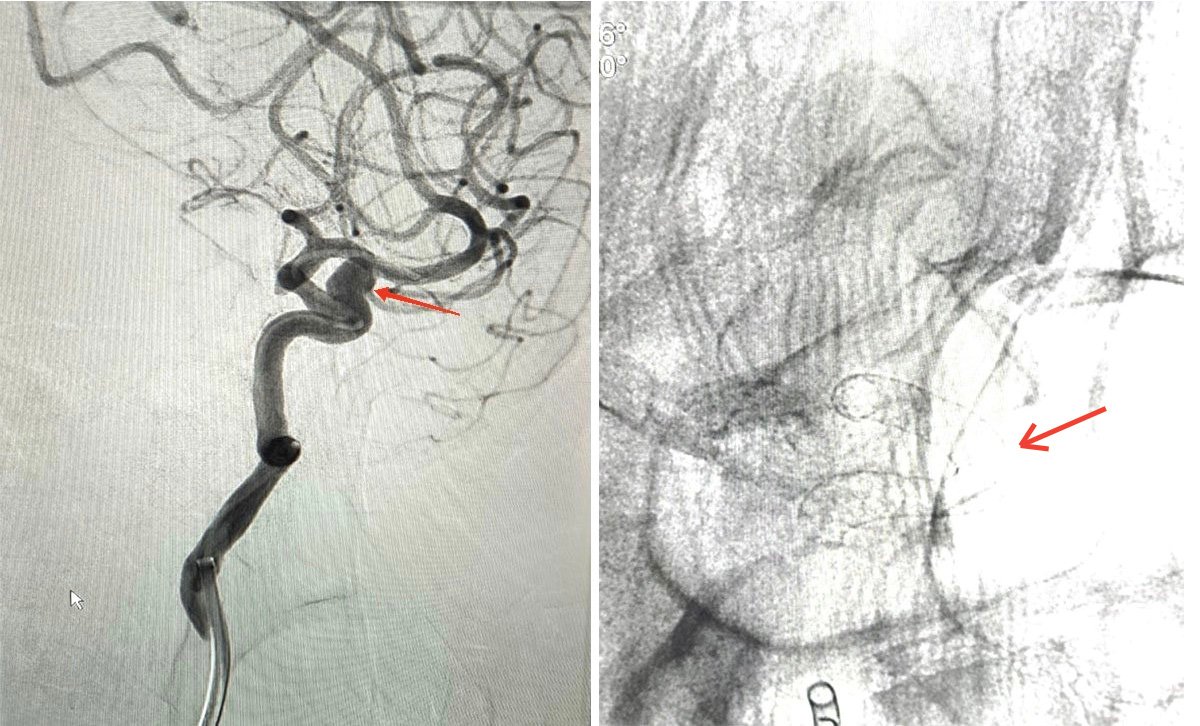 Mạch máu não trước & sau can thiệp. Sau khi đặt stent nở tốt, đúng vị trí