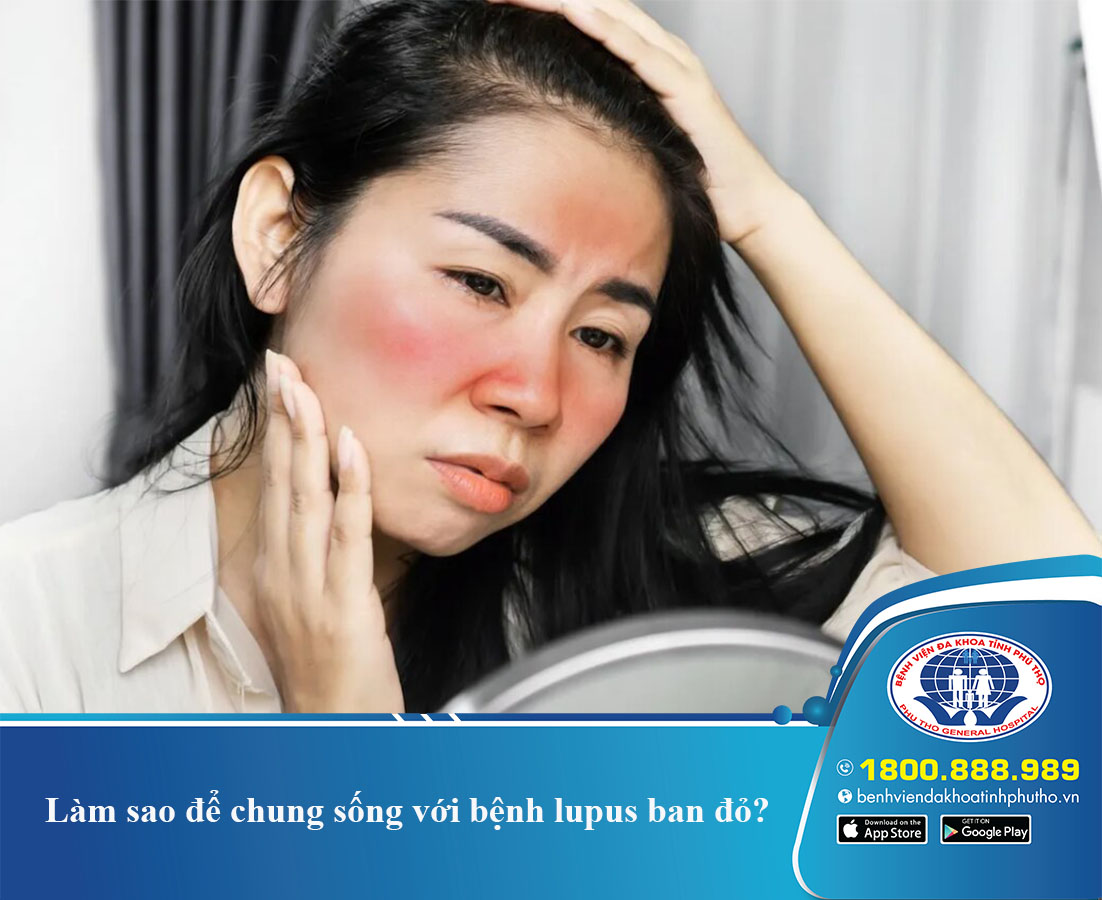 Làm sao để chung sống với bệnh lupus ban đỏ?