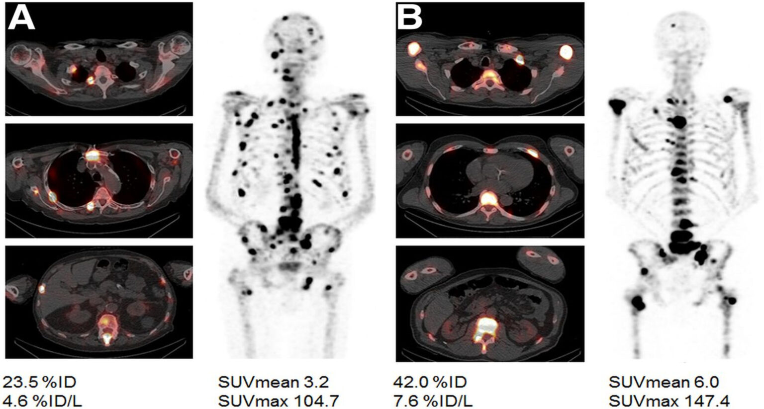 Chính thức vận hành Máy xạ hình thế hệ mới Spect/CT trong chẩn đoán và ...